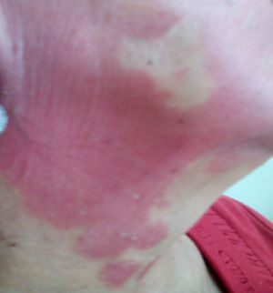 Lesiones cutáneas eritematosas en zona facial y cervical de la paciente.