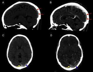 Imágenes sagitales (A, B) y axiales (C, D) de TC de cráneo sin y con contraste IV, respectivamente. Presencia de hiperdensidad de la porción más posterior del seno sagital superior (flechas negras), de la tórcula (flecha blanca) y del seno transverso izquierdo (flecha negra con rayas entrecortadas) en TC sin contraste IV, con defecto de repleción tras la administración de contraste IV en dicha localización, indicativo de trombosis de senos venosos.