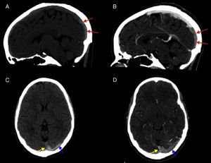 Imagen axial (A) y sagital (B) de RM de cráneo con gadolinio IV potenciadas en T1 que confirman la presencia de trombosis en la tórcula (flecha blanca), el seno transverso izquierdo (flecha negra con rayas entrecortadas) y la porción posterior del seno sagital superior (flechas negras).