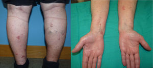 Lesiones múltiples tipo placa fina eritematoescamosas en piernas y antebrazos.