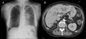 A. Rx de tórax con masa parahiliar izquierda con atelectasia completa del lóbulo superior. B. TAC abdominal con múltiples LOE hepáticas metastásicas.