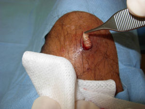 Extracción de la larva de lesión forunculoide a nivel pretibial derecho.