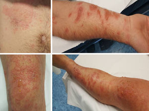 Lesiones vesiculoampollosas sobre base eritematosa en tronco y extremidades.