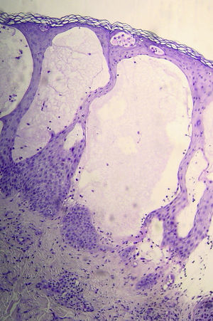 Corte histológico teñido con hematoxilina-eosina de una lesión ampollosa mostrando despegamiento subepidérmico.