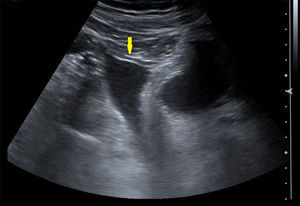 En la ecografía se descubrió líquido libre en la cavidad abdominal, hallazgo por el que se decidió realizar la TAC dado que no se observaba dolencia ecográficamente (señalado con flecha).