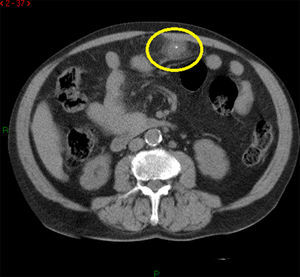En esta fotografía podemos observar un corte tomográfico de la isquemia omental, que se muestra como una lesión de densidad grasa, de bordes mal definidos y con imágenes de mayor densidad en su interior (señalado con círculo).
