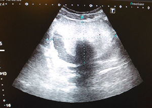 Ecografía de abdomen.