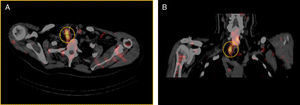 Imagen del tumor paratiroideo derecho, localizado en la zona cervical posterior en situación paraesofágica, mediante SPECT-TC (círculo discontinuo) tras la realización previa de gammagrafía paratiroidea con radiofármaco 99mTc-sestamibi. A: corte transversal; B: corte longitudinal.
