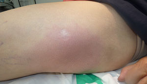 Placa eritematosa y edematosa bien delimitada, localizada en muslo izquierdo.