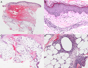 A) Leve infiltrado perivascular superficial dérmico y subcutáneo. B) La epidermis no muestra alteraciones y el infiltrado dérmico es linfohistiocitario con algunos eosinófilos. C) La hipodermis muestra un infiltrado septal y lobular (mixto). D) El infiltrado en el panículo se acompaña de abundantes eosinófilos pero sin figuras en llama.