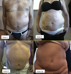 Parálisis abdominal: caso 1 (agosto 2008); caso 2 (diciembre 2010); caso 3 (agosto 2012) y caso 10 (marzo 2016).