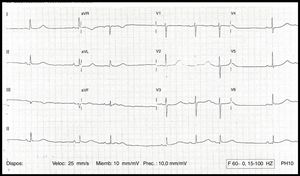 ECG del caso: QT largo (720ms) y QTc 640ms.