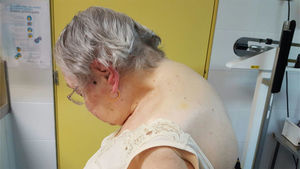 Fotografía de la paciente de perfil en la que se evidencia cifosis cervical de «mentón-tórax».