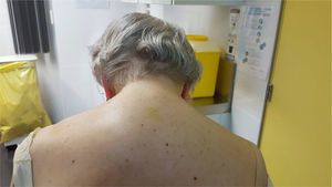 Fotografía de la paciente postero-anterior en la que se evidencia cifosis cervical.