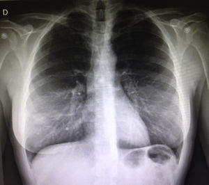 Radiografía de tórax: infiltrado reticular bilateral.