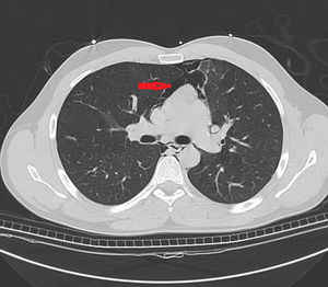 Imagen de TC torácica que muestra neumomediastino, con extensión del aire hasta la región cervical (flecha). En el informe de la TC se recoge la existencia de pequeños neumotórax bilaterales, pequeñas atelectasias subsegmentarias a nivel lingular, así como a nivel del lóbulo inferior izquierdo. No se evidencian imágenes indicativas de nódulos a nivel de parénquima pulmonar.