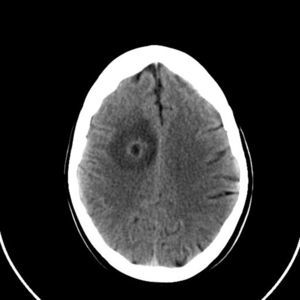Absceso en región frontal derecha con edema perilesional.