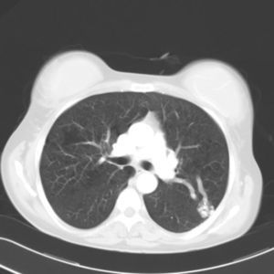 Fístula arteriovenosa en segmento apicoposterior del LSI.