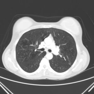 Embolización de la fístula AV con coils.