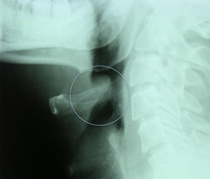 Radiografía cervical lateral. Inflamación epiglotis.