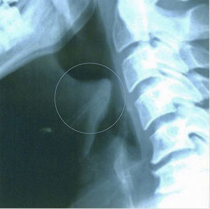 Radiografía cervical lateral con «signo del pulgar».