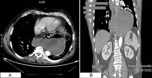 A y B. TAC de tórax. Estómago intratorácico, distendido, comprimiendo estructuras cardíacas. Imagen compatible con hernia paraesofágica gigante.