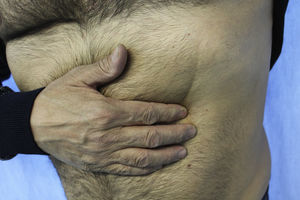 Placa indurada en hemitórax izquierdo.