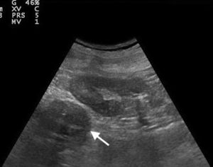 Tumoración adrenal izquierda (flecha) demostrada por ecografía en el punto de atención al paciente, observándose una lesión isoecogénica en comparación con el parénquima renal.