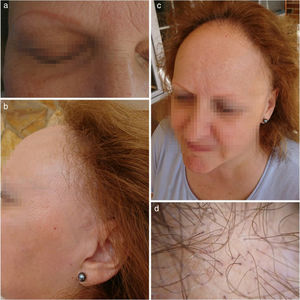 a) Alopecia completa de las cejas disimulado por tatuaje; b) Retroceso de la línea de implantación del pelo; c) Visión completa del retroceso de la línea fronto-temporal y alopecia de las cejas, y d) Imagen de cuero cabelludo ampliada donde se observa eritema e hiperqueratosis folicular (AFF en fase activa).