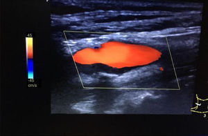 Imagen ecográfica de placa hipoecogénica, heterogénea y calcificada (sombra posterior) en carótida interna derecha que ecográficamente parece un trombo.