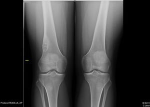 Radiografía anteroposterior de ambas rodillas. Fibroma no osificante en la diáfisis distal femoral de la rodilla derecha.