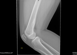 Radiografía lateral de la rodilla derecha. Fibroma no osificante en la diáfisis distal femoral.