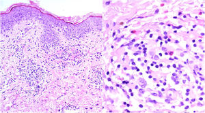 Infiltrado perivascular superficial de células inflamatorias típico del síndrome de SDRIFE.