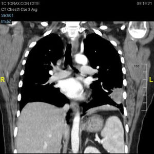 Condensación pulmonar basal izquierda, de morfología triangular y base pleural con broncograma aéreo y engrosamiento pleural asociado.