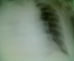 Proyección posteroanterior de radiografía de tórax con portátil, donde se aprecia afectación pulmonar con derrame pleural derecho total.