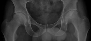 Radiología simple de ambas caderas del paciente, con imágenes sugerentes de necrosis avascular (áreas radiolucentes parcheadas junto a zonas de hiperdensidad e irregularidad de ambas cabezas femorales).