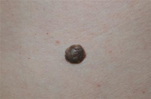 Nevus verrugoso.