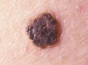 Queratosis seborreica.