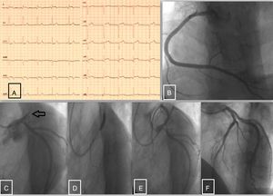 A) Electrocardiograma en urgencias. B) Arteria coronaria derecha sin lesiones angiográficas significativas. C) Oclusión trombótica proximal de la arteria descendente anterior; circunfleja sin lesiones angiográficas. D) Angioplastia con stent farmacoactivo de la arteria descendente anterior. E y F) Resultado final postangioplastia con stent farmacoactivo.