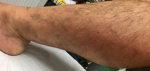 Miembro inferior izquierdo con datos de trombosis venosa superficial.