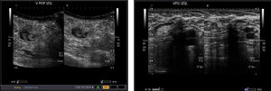 Ecografía doppler que muestra trombosis superficial venosa de miembro inferior izquierdo con afectación de vena poplítea izquierda y cayado femoral izquierdo.