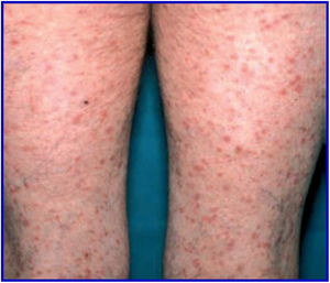 Lesiones máculo-papulares eritematosas y descamativas, algunas vesículo-pústulas y costras con necrosis central levemente pruriginosas, localizadas en piernas.