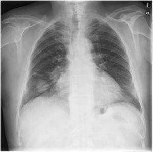 Radiografía de tórax con hilio derecho aumentado y nódulo en base pulmonar derecha.
