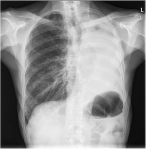 Radiografía de tórax con opacificación completa del hemitórax izquierdo con importante pérdida de volumen del pulmón izquierdo.