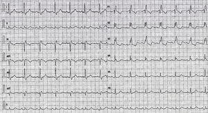 El ECG del paciente muestra un intervalo PR normal y un bloqueo completo de rama derecha.