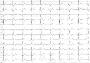 ECG durante la ergometría: muestra bloqueo AV 2:1.