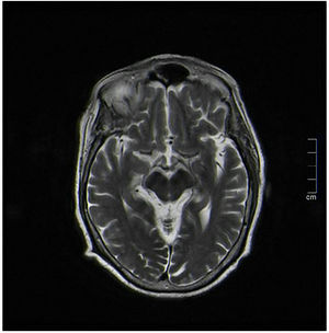 Imagen de resonancia magnética (RMN) cerebral que muestra una discreta hiposeñal difusa en T2 capsulolenticular bilateral de significado inespecífico.