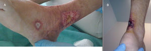A) Úlcera de bordes eritematosos en zona maleolar externa. B) Úlcera con placa necrótica en región aquílea, zona típica de aparición de las úlceras de Martorell.
