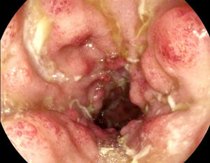 Colon descendente, con mucosa eritematosa y friable y úlceras serpiginosas.