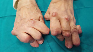 Deformidad de manos en etapa tardía en artritis reumatoide, con desviación cubital de articulaciones metacarpofalángicas, deformidad en cuello de cisne de los dedos y deformidad en ojal del pulgar.